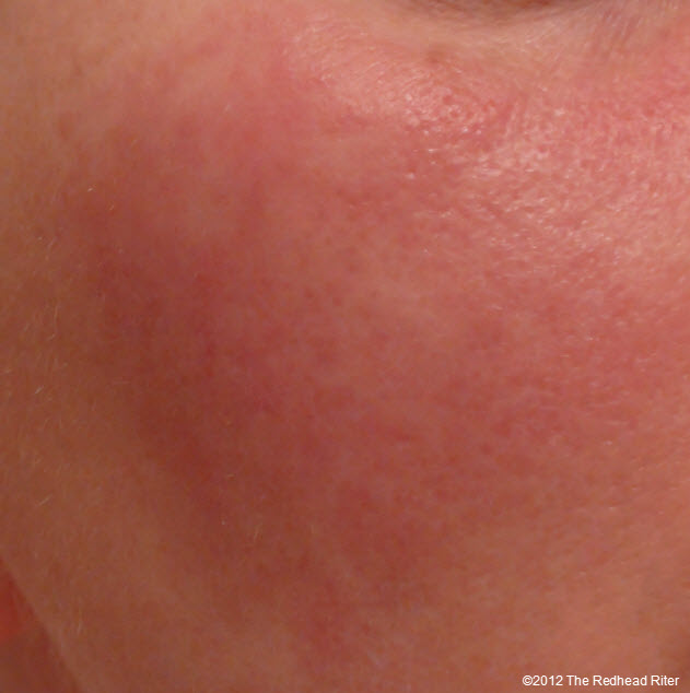 face rash allergy #10